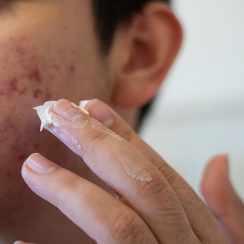 Kandungan Skincare yang Tidak Boleh untuk Kulit Berjerawat, Hati-Hati!